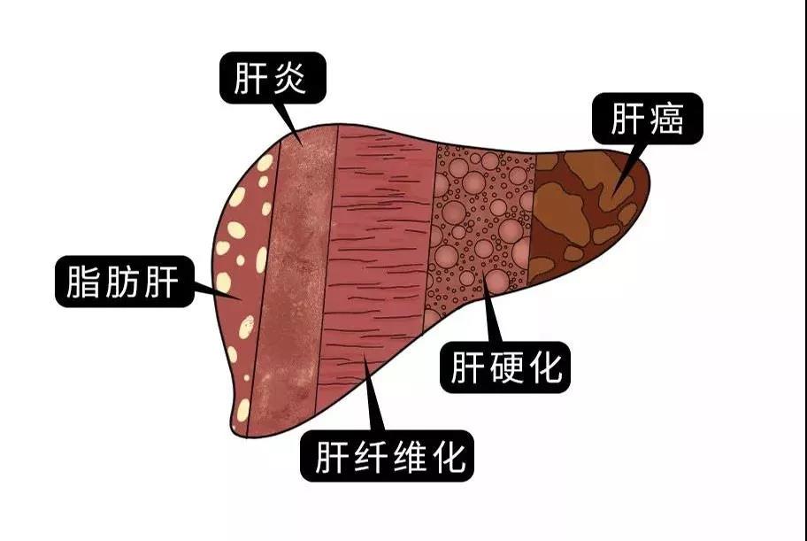 脂肪肝的最大敵人不是肥胖，答案竟是這樣！