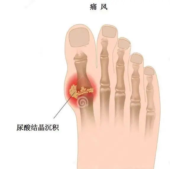 痛風(fēng)為什么偏愛(ài)男性？你最關(guān)心的問(wèn)題都在這里