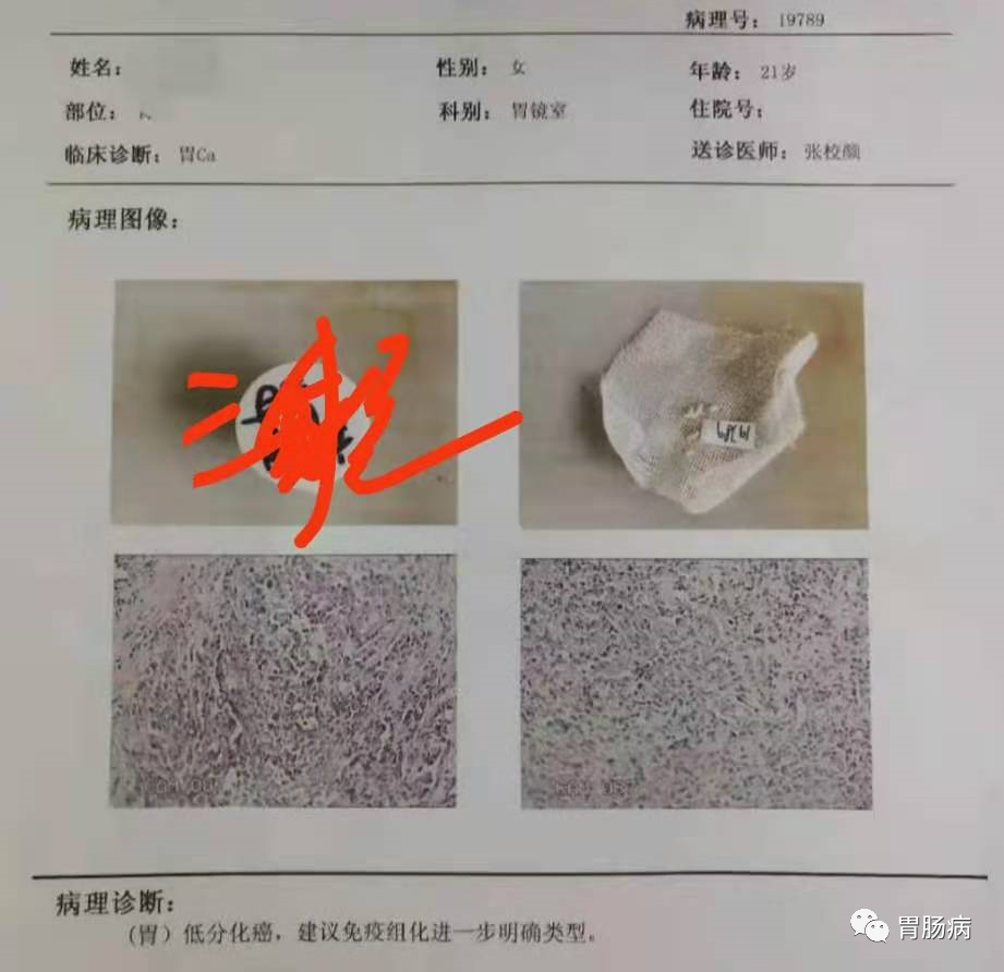 醫生總結了3位年輕胃癌患者的病例：30歲不到的他們到底干啥了？