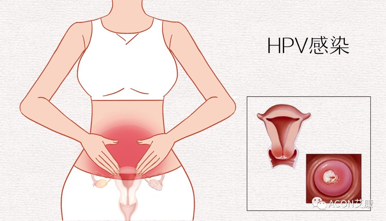 HPV轉陰其實(shí)很簡(jiǎn)單， 女性必知的宮頸癌真相