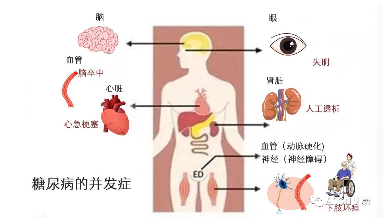 爆上熱搜，因爆發(fā)型糖尿病進(jìn)入ICU，有哪些教訓值得我們汲取