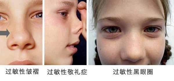 過(guò)敏性鼻炎會(huì )讓孩子變傻？！家長(cháng)該如何應對